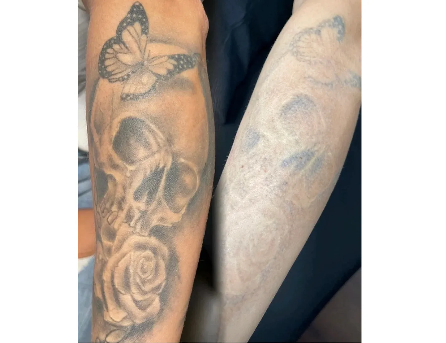 Unterarm-Tattoo vor und nach mehreren Laserbehandlungen