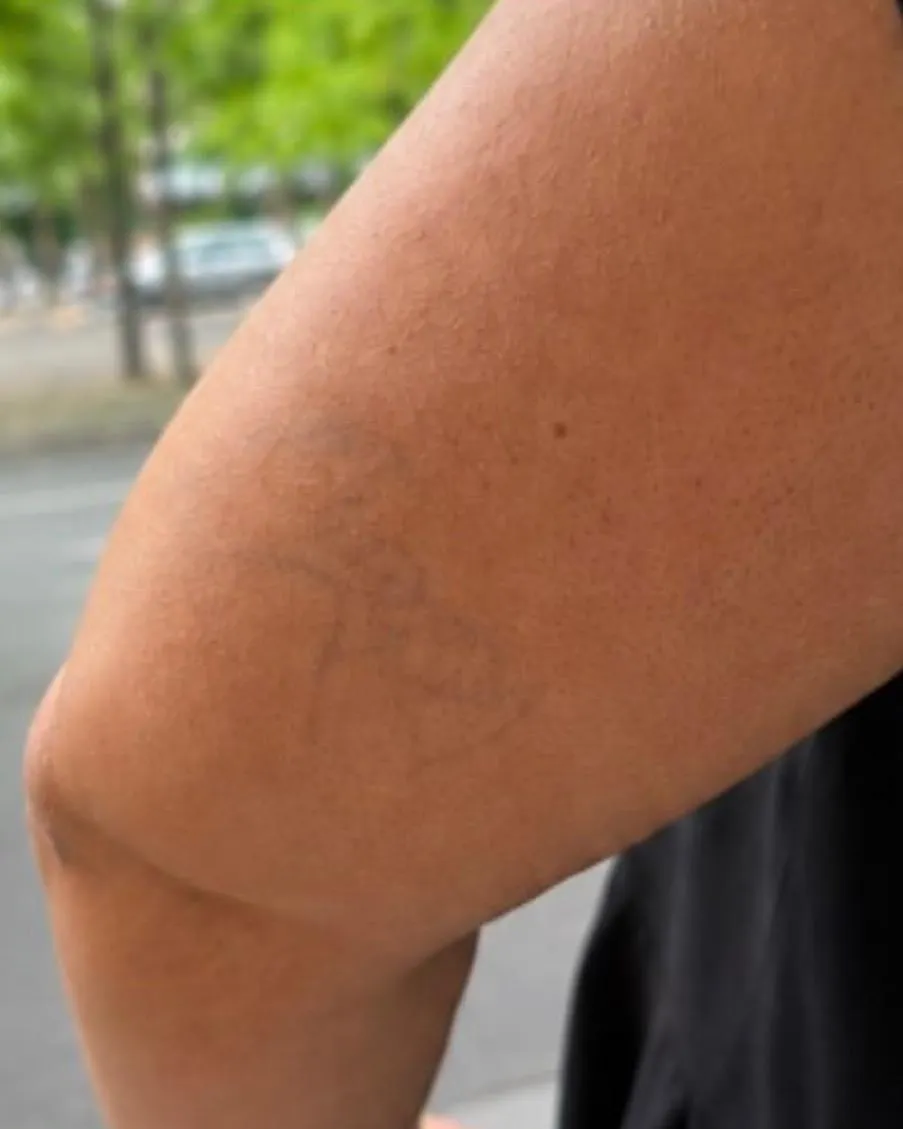 Derselbe Oberarm nach der Tattooentfernung mit dem Laser