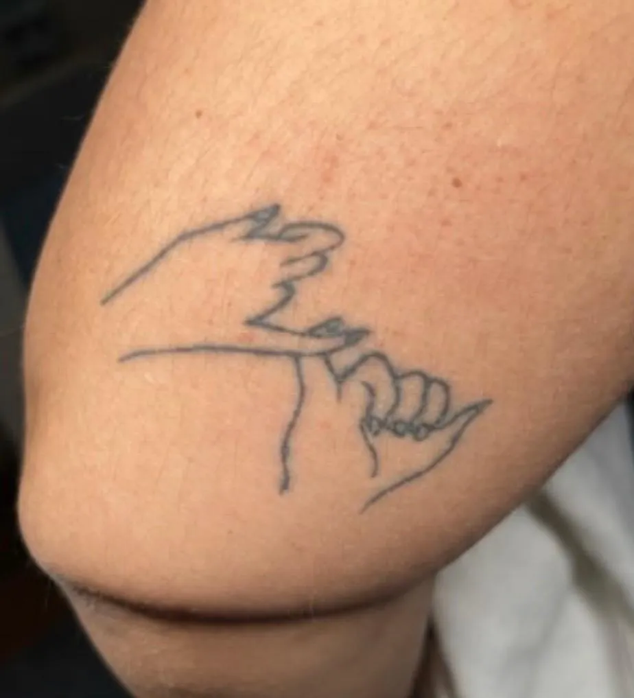 Tattoo am Oberarm vor der Laserbehandlung